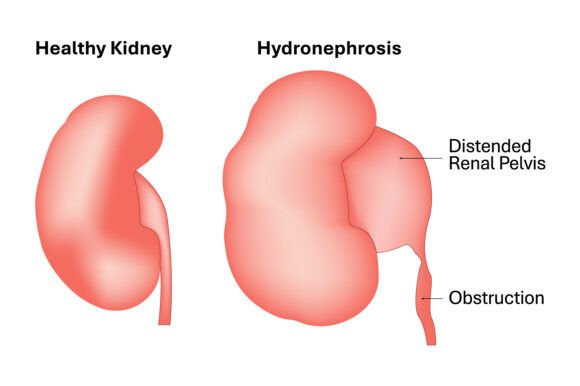 Hydronephrosis Vs Healthy Kidney Medical